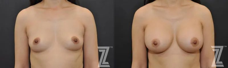 Austin Front view of Before & After image of woman with Silicone Implants with Highly Cohesive Gel (Gummy Bear Implants) - The Piazza Center