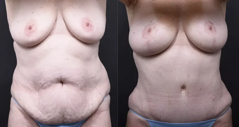 Austin Tummy Tuck Before & After Gallery - Patient 101511 - Image 1 - The Piazza Center