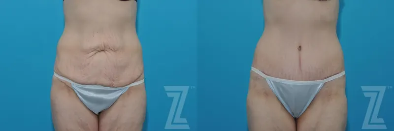 Austin Tummy Tuck Before & After Gallery - Patient 132886817 - Image 1 - The Piazza Center