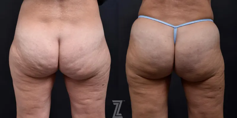 Austin Avéli Before & After Gallery - Patient 132905402 - Image 1 - The Piazza Center