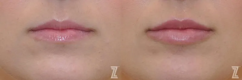 Austin Injectable Fillers Before & After Gallery - Patient 132963115 - Image 1 - The Piazza Center