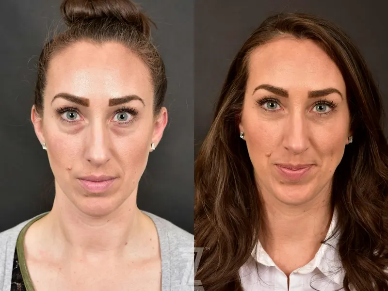 Austin Injectable Fillers Before & After Gallery - Patient 132963104 - Image 1 - The Piazza Center