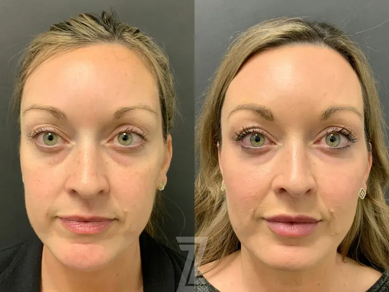 Austin Facial Rejuvenation Before & After Gallery - Patient 184295 - Image 1 - The Piazza Center