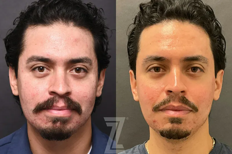 Austin Clear Skin Protocol Before & After Gallery - Patient 279974 - Image 1 - The Piazza Center