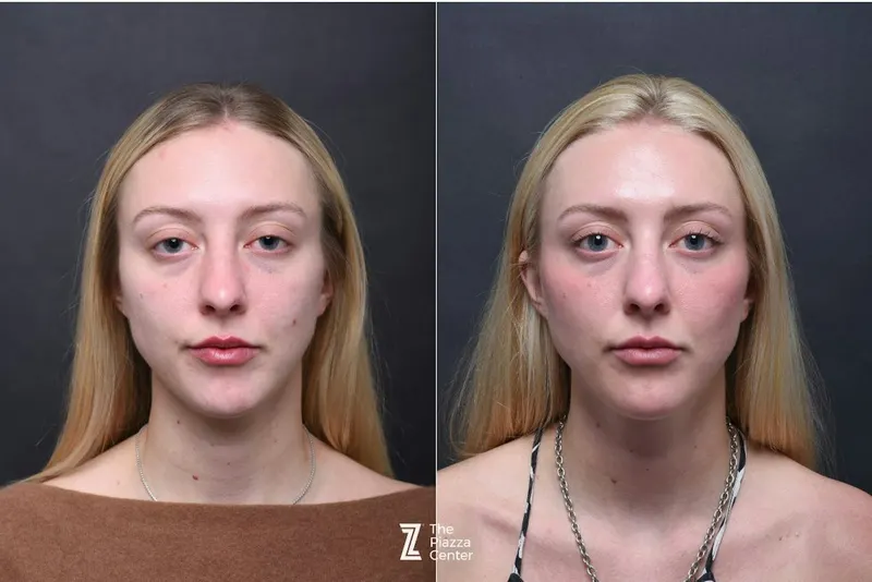 Austin Wrinkle Relaxers Before & After Gallery - Patient 119754 - Image 1 - The Piazza Center