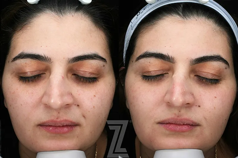 Austin Moxi Before & After Gallery - Patient 216408 - Image 1 - The Piazza Center