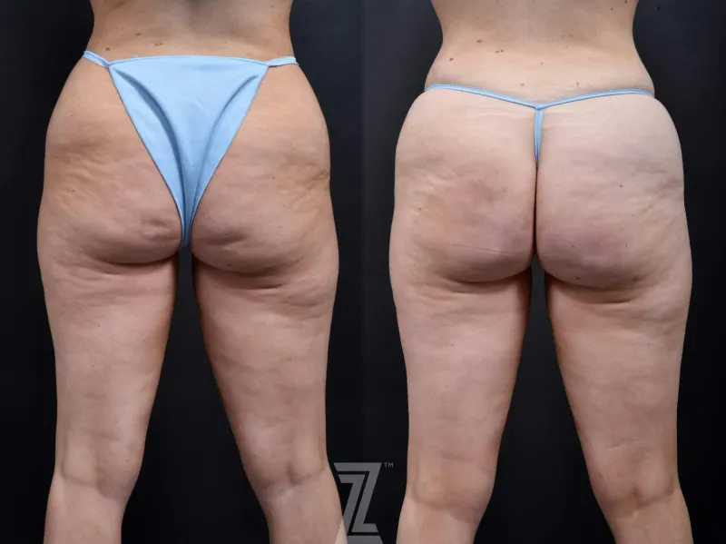 Austin Avéli Before & After Gallery - Patient 132905400 - Image 1 - The Piazza Center