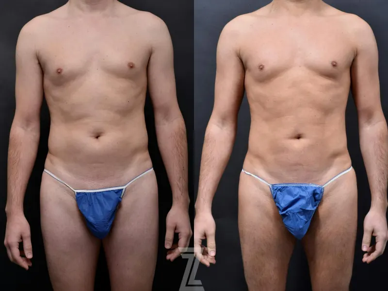 Austin Liposuction Before & After Gallery - Patient 132886947 - Image 1 - The Piazza Center