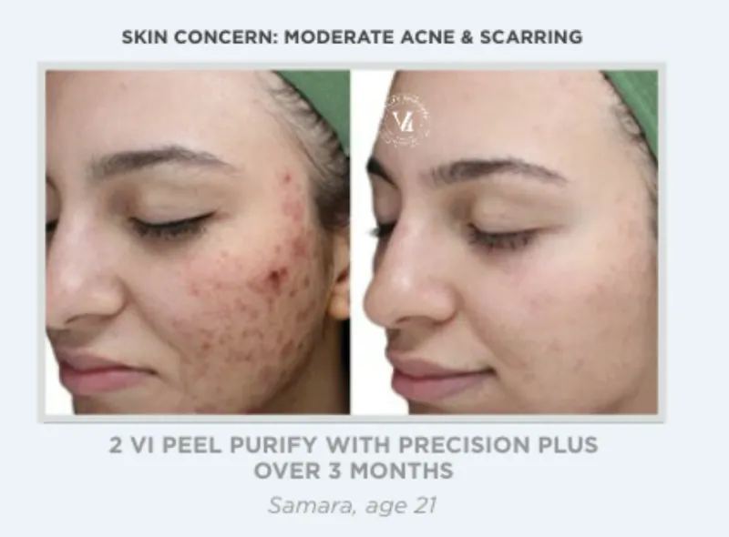 Austin VI Peel Before & After Gallery - Patient 837973 - Image 1 - The Piazza Center
