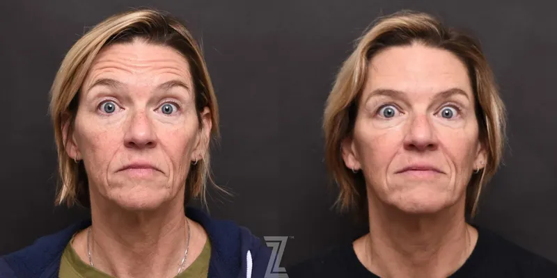 Austin Wrinkle Relaxers Before & After Gallery - Patient 132905408 - Image 1 - The Piazza Center