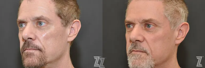 Austin Sculptra® Before & After Gallery - Patient 132963133 - Image 1 - The Piazza Center