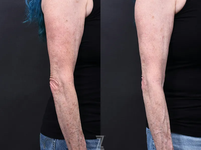 Austin BBL Before & After Gallery - Patient 344560 - Image 1 - The Piazza Center