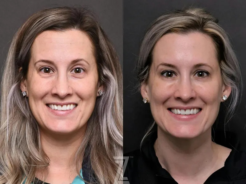 Austin Injectable Fillers Before & After Gallery - Patient 132963122 - Image 1 - The Piazza Center