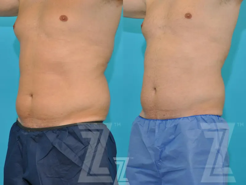 Austin Non-Surgical Male Body Contouring Before & After Gallery - Patient 250517 - Image 1 - The Piazza Center