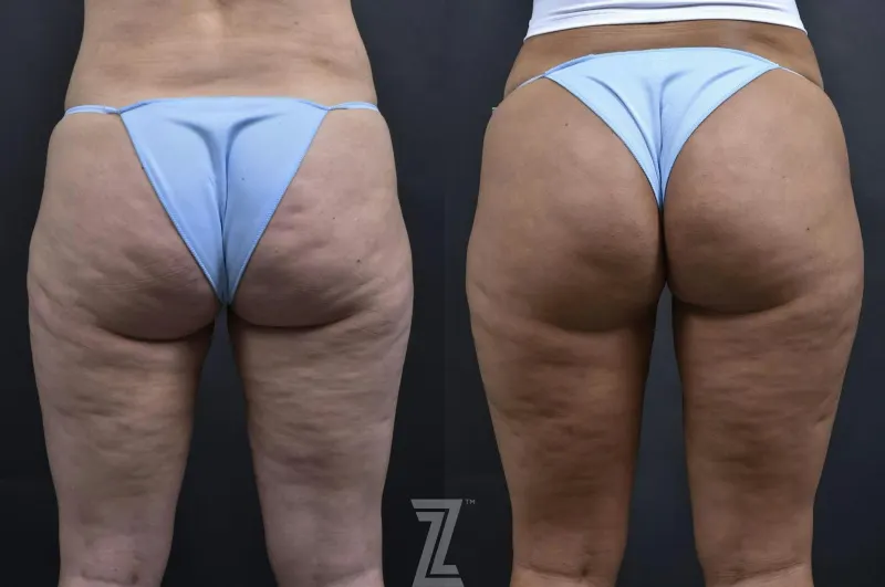 Austin Profound® RF Microneedling Before & After Gallery - Patient 132963580 - Image 1 - The Piazza Center