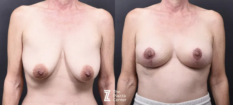 Austin Breast Augmentation With a Breast Lift - The Piazza Center