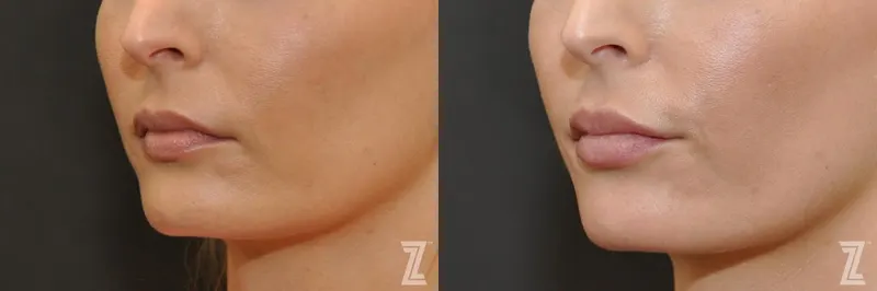 Austin Injectable Fillers Before & After Gallery - Patient 132963103 - Image 1 - The Piazza Center