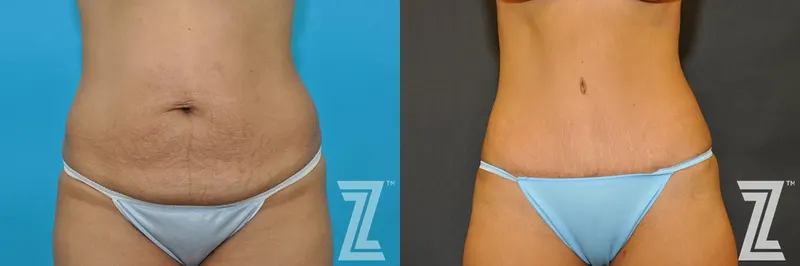 Austin Tummy Tuck Before & After Gallery - Patient 132886888 - Image 1 - The Piazza Center