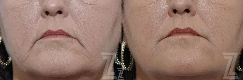 Austin Injectable Fillers Before & After Gallery - Patient 132963113 - Image 1 - The Piazza Center