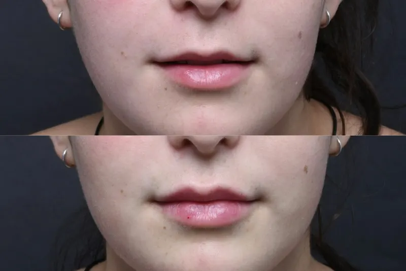 Austin Injectable Fillers Before & After Gallery - Patient 712627 - Image 1 - The Piazza Center
