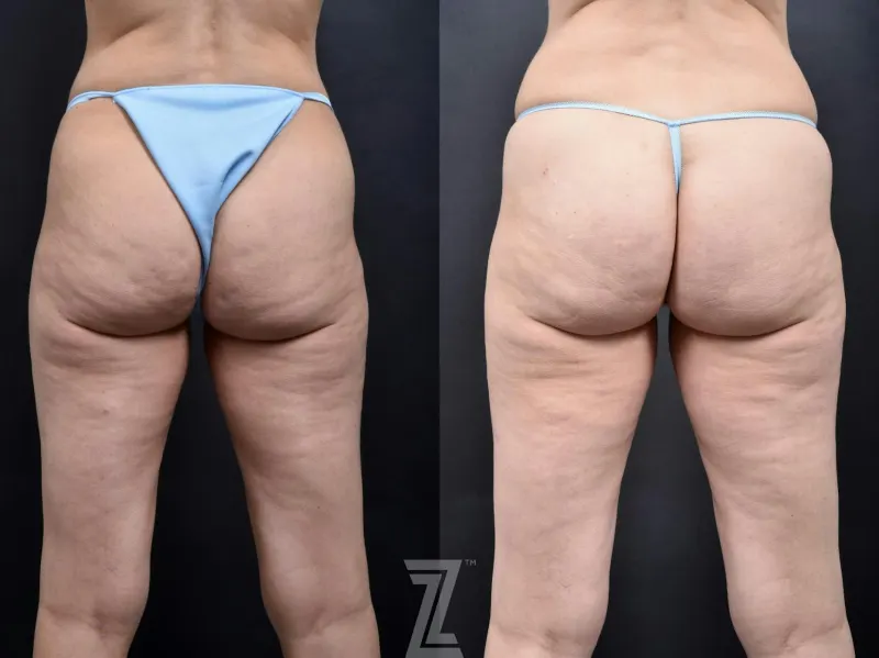 Austin Avéli Before & After Gallery - Patient 132905407 - Image 1 - The Piazza Center