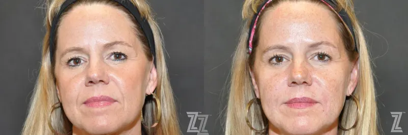 Austin Facial Rejuvenation Before & After Gallery - Patient 186050 - Image 1 - The Piazza Center