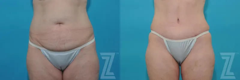 Austin Tummy Tuck Before & After Gallery - Patient 132886814 - Image 1 - The Piazza Center