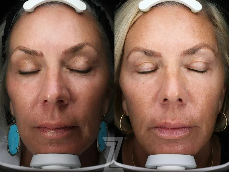 Austin SkinPen Microneedling Before & After Gallery - Patient 362150 - Image 1 - The Piazza Center