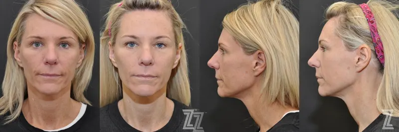 Austin Chemical Peel Before & After Gallery - Patient 132963245 - Image 1 - The Piazza Center