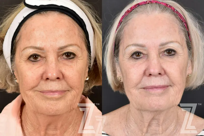 Austin HALO Before & After Gallery - Patient 132963261 - Image 1 - The Piazza Center