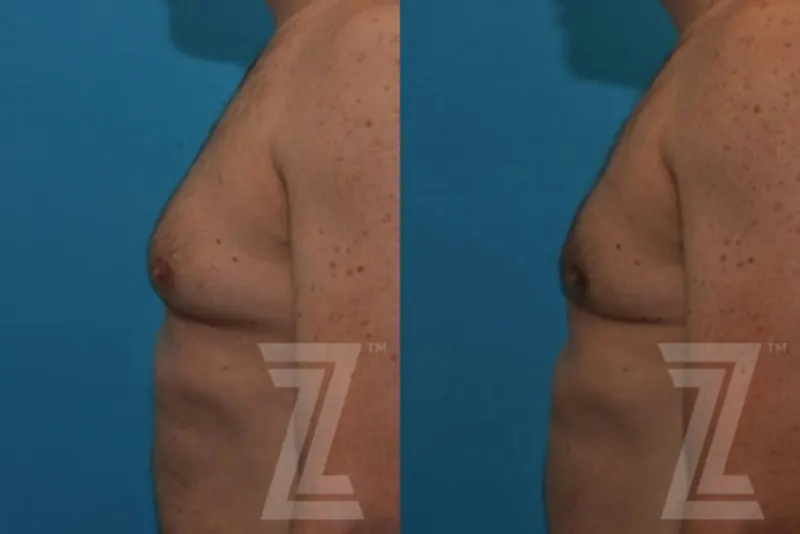 Austin Male Breast Reduction Before & After Gallery - Patient 132963592 - Image 1 - The Piazza Center