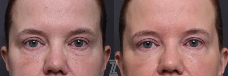 Austin ezGEL Before & After Gallery - Patient 257626 - Image 1 - The Piazza Center