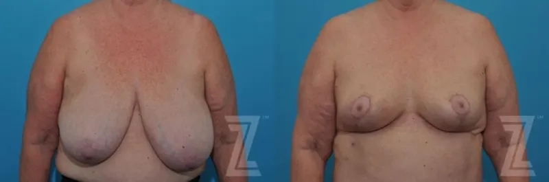 Austin Breast Reduction Before & After Gallery - Patient 132886611 - Image 1 - The Piazza Center