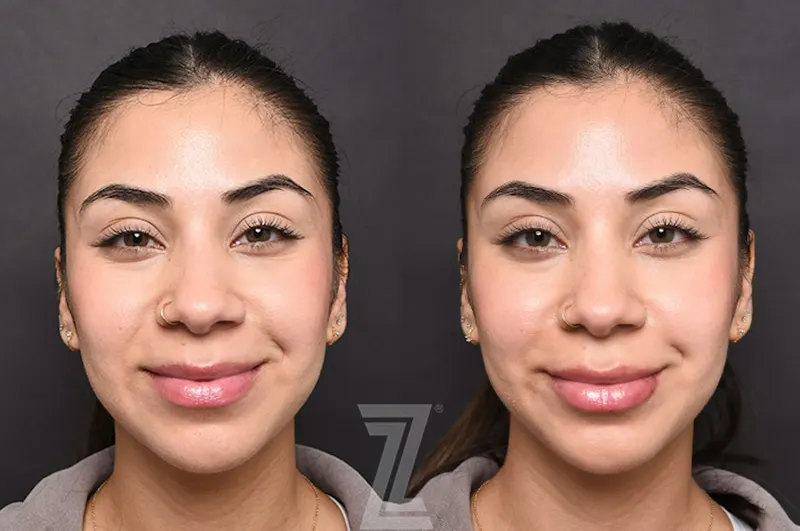 Austin Injectable Fillers Before & After Gallery - Patient 353710 - Image 1 - The Piazza Center
