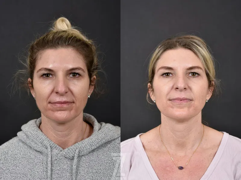 Austin Wrinkle Relaxers Before & After Gallery - Patient 132906304 - Image 1 - The Piazza Center