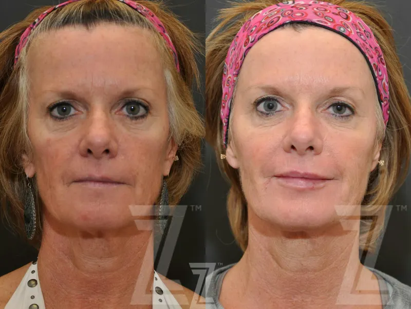 Austin Injectable Fillers Before & After Gallery - Patient 132963114 - Image 1 - The Piazza Center