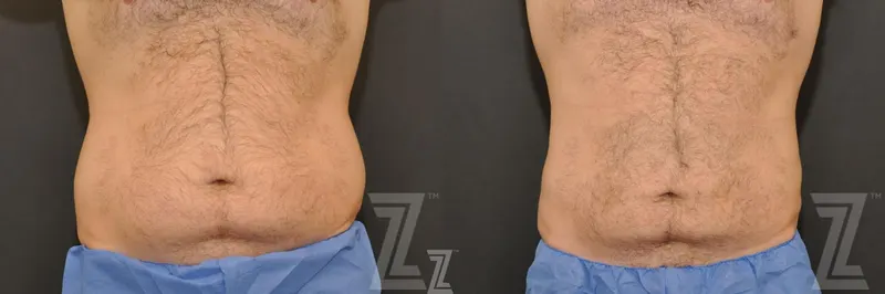 Austin Non-Surgical Male Body Contouring Before & After Gallery - Patient 195719 - Image 1 - The Piazza Center