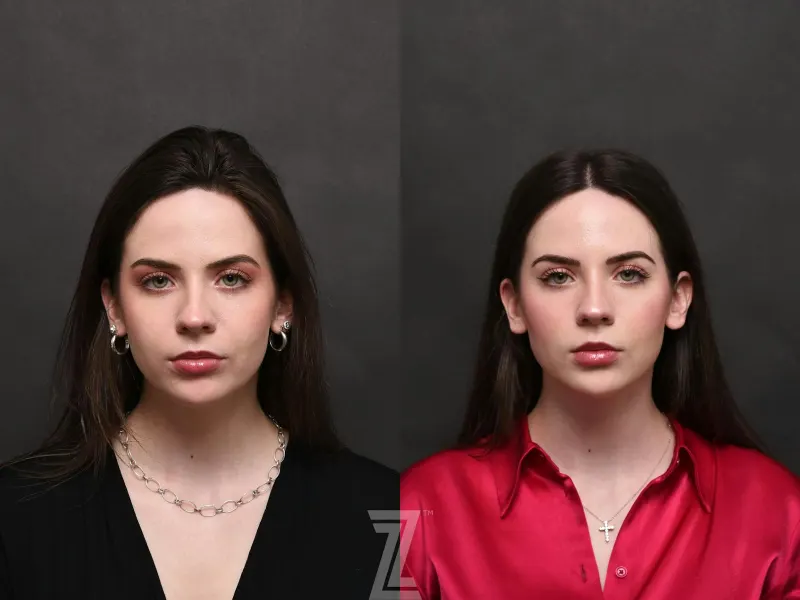 Austin Injectable Fillers Before & After Gallery - Patient 132963119 - Image 1 - The Piazza Center