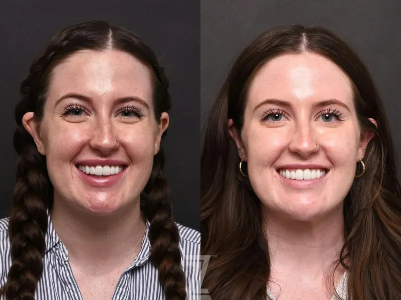 Austin Wrinkle Relaxers Before & After Gallery - Patient 132906322 - Image 1 - The Piazza Center
