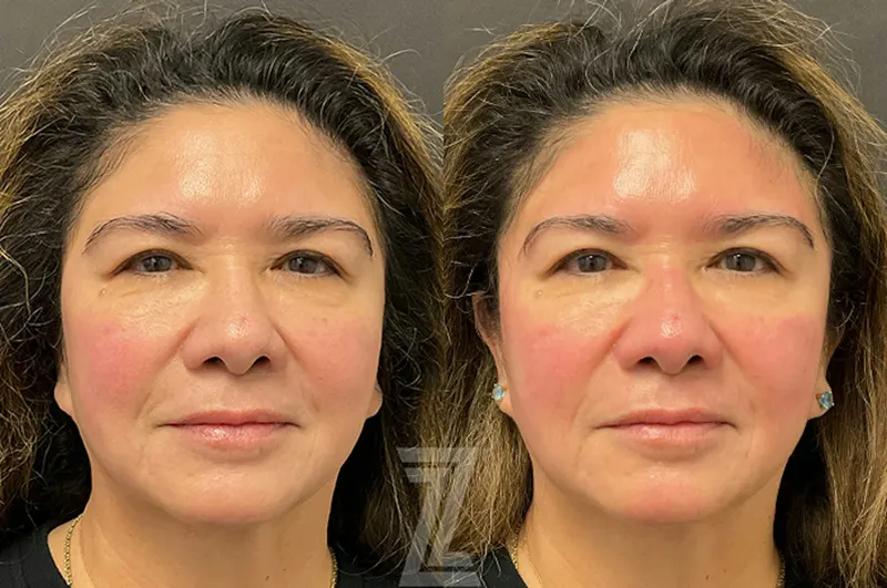 Austin HydraFacial™ Before & After Gallery - Patient 384379 - Image 1 - The Piazza Center