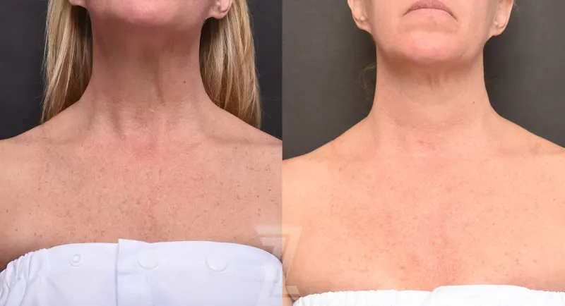 Austin HALO Before & After Gallery - Patient 327066 - Image 1 - The Piazza Center