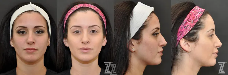 Austin Chemical Peel Before & After Gallery - Patient 132963250 - Image 1 - The Piazza Center