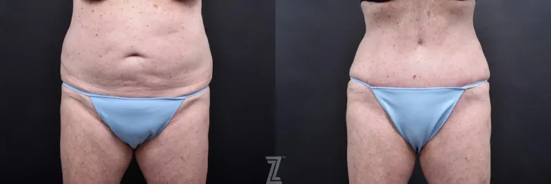 Austin Tummy Tuck Before & After Gallery - Patient 132886796 - Image 1 - The Piazza Center