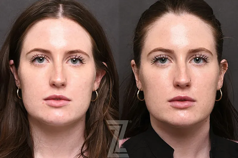 Austin Chemical Peel Before & After Gallery - Patient 207164 - Image 1 - The Piazza Center