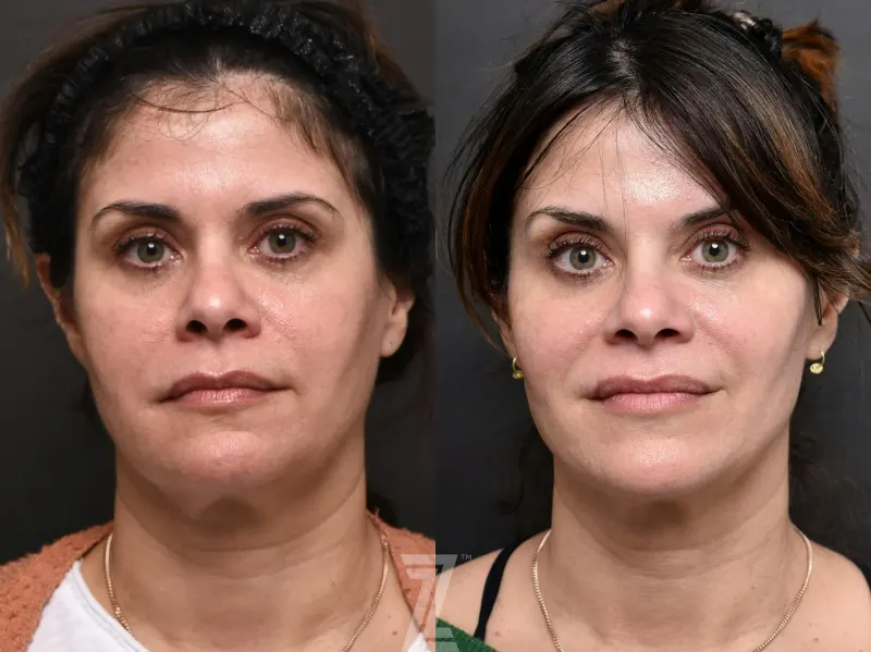 Austin Injectable Fillers Before & After Gallery - Patient 132946326 - Image 1 - The Piazza Center