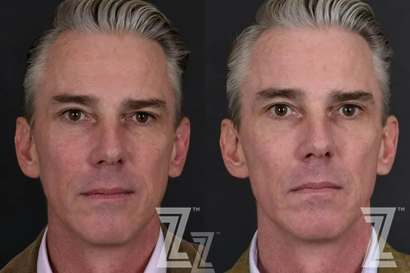 Austin Male Skin Treatments Before & After Gallery - Patient 336028 - Image 1 - The Piazza Center
