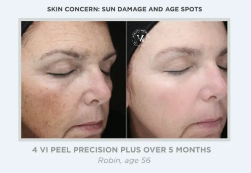 Austin VI Peel Before & After Gallery - Patient 156434 - Image 1 - The Piazza Center