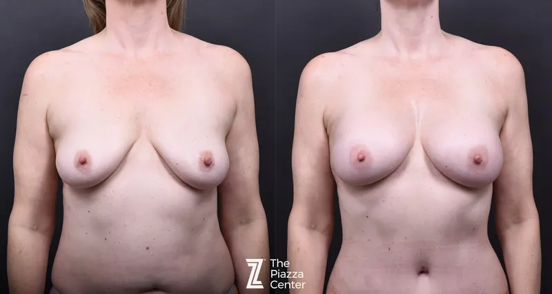 Austin Fat Transfer Breast Augmentation Before & After Gallery - Patient 405303 - Image 1 - The Piazza Center