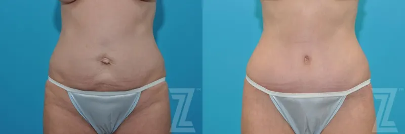 Austin Tummy Tuck Before & After Gallery - Patient 132886905 - Image 1 - The Piazza Center