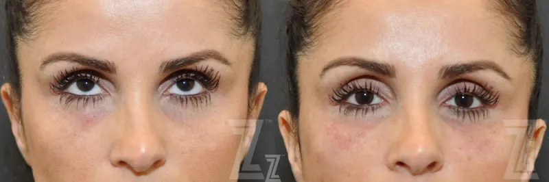 Austin Injectable Fillers Before & After Gallery - Patient 132963099 - Image 1 - The Piazza Center